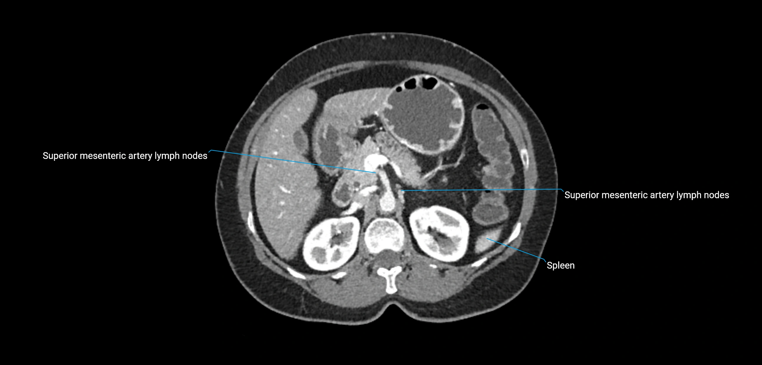 CT ct abdominal lymph nodes  axial cross sectional anatomy  enchanced radiology image -img-00002-00159.webp